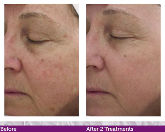 image of a woman's facial skin clearing before and after two treatments