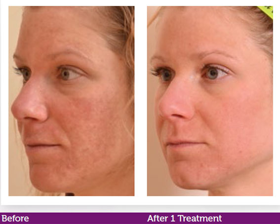 images of a woman's facial skin before treatment and clearing after one treatment