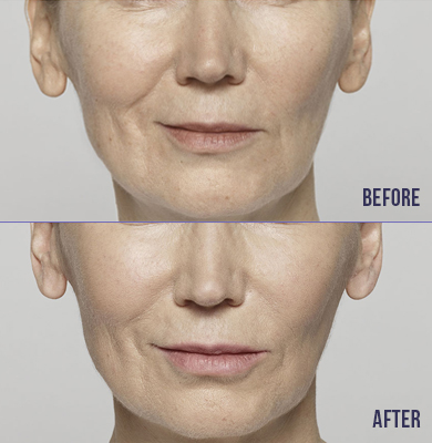 Image of improvement before and after restylane lyft