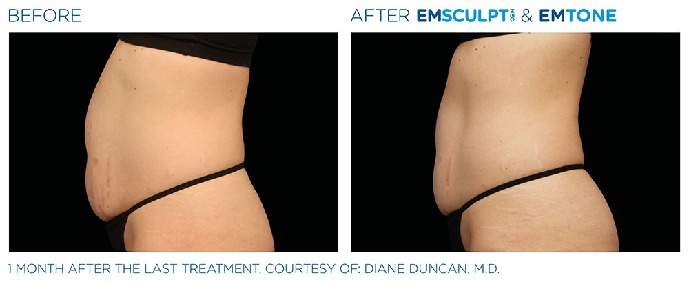 Emsculpt_Neo-Before-and-After Before and After Emscuplt Neo